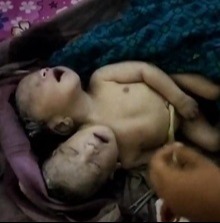 বাগআঁচড়ায় দুই মাথা নিয়ে শিশুর জন্ম, পরে মৃত্যু