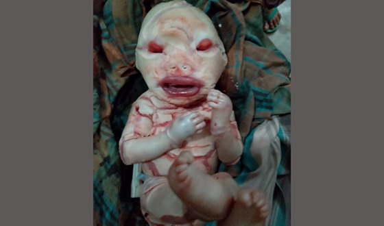 চিলমারীতে অস্বাভাবিক শিশুর জন্ম উৎসুক জনতার ভীড়