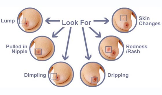 স্তন ক্যানসার প্রতিরোধে নারীদের যা করা উচিত!