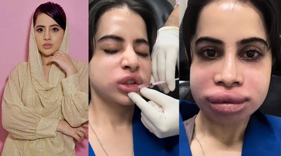 ঠোঁটে ফিলার ভাঙিয়ে বিপাকে উরফি, দিলেন সতর্কবার্তা