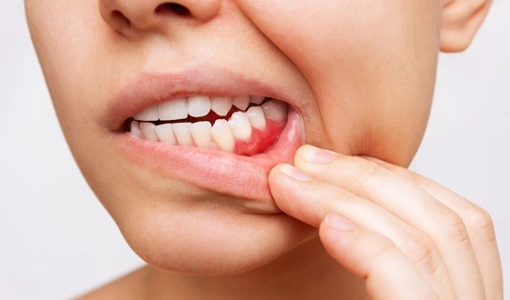 দাঁত ও মাড়ি থেকে রক্ত পড়লে যা করণীয়