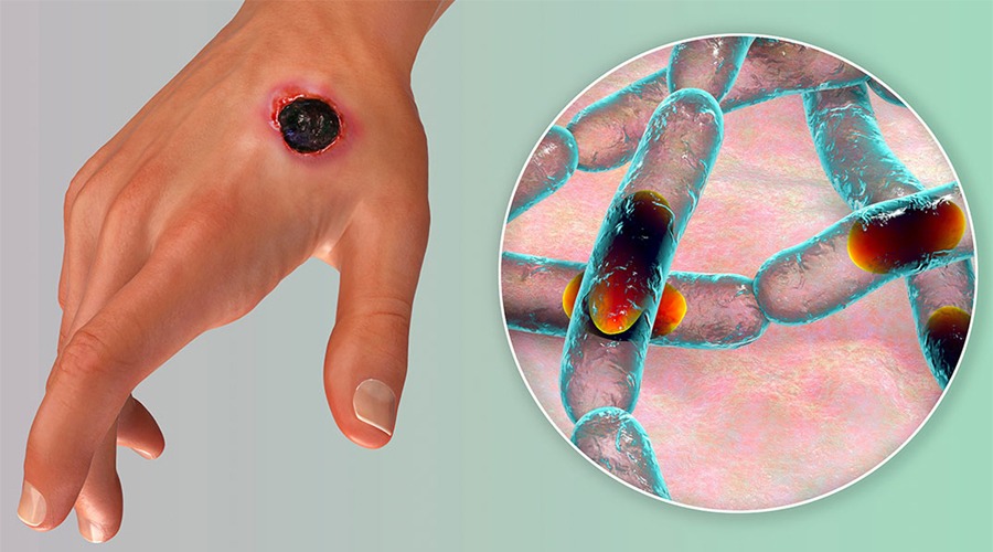 গাইবান্ধায় গরু থেকে মানুষের গায়ে অ্যানথ্রাক্স উপসর্গ