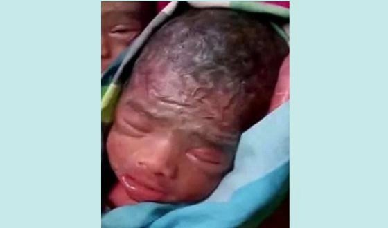 একসঙ্গে জন্ম নেওয়া জমজ ৬ শিশুর মধ্যে মারা গেল ৫ জন
