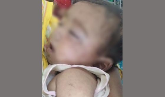 কুষ্টিয়ায় হামে আক্রান্ত শিশুর মৃত্যু