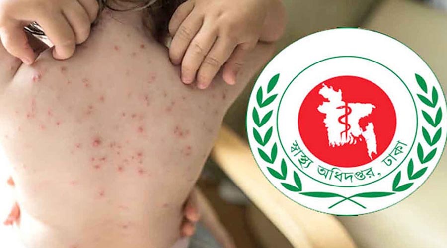 হামের উপসর্গে আরও ৬ শিশুর মৃত্যু, ২৪ ঘণ্টায় আক্রান্ত ৮১৮