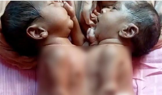 এক দেহে দুই প্রাণ জমজ শিশুর চিকিৎসার ভার নিয়েছে সরকার