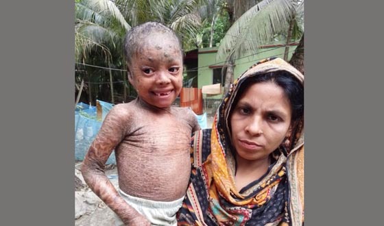 চর্মরোগে আক্রান্ত ছোট্ট তানিয়াকে বাঁচাতে দরকার সবার সহানুভূতি