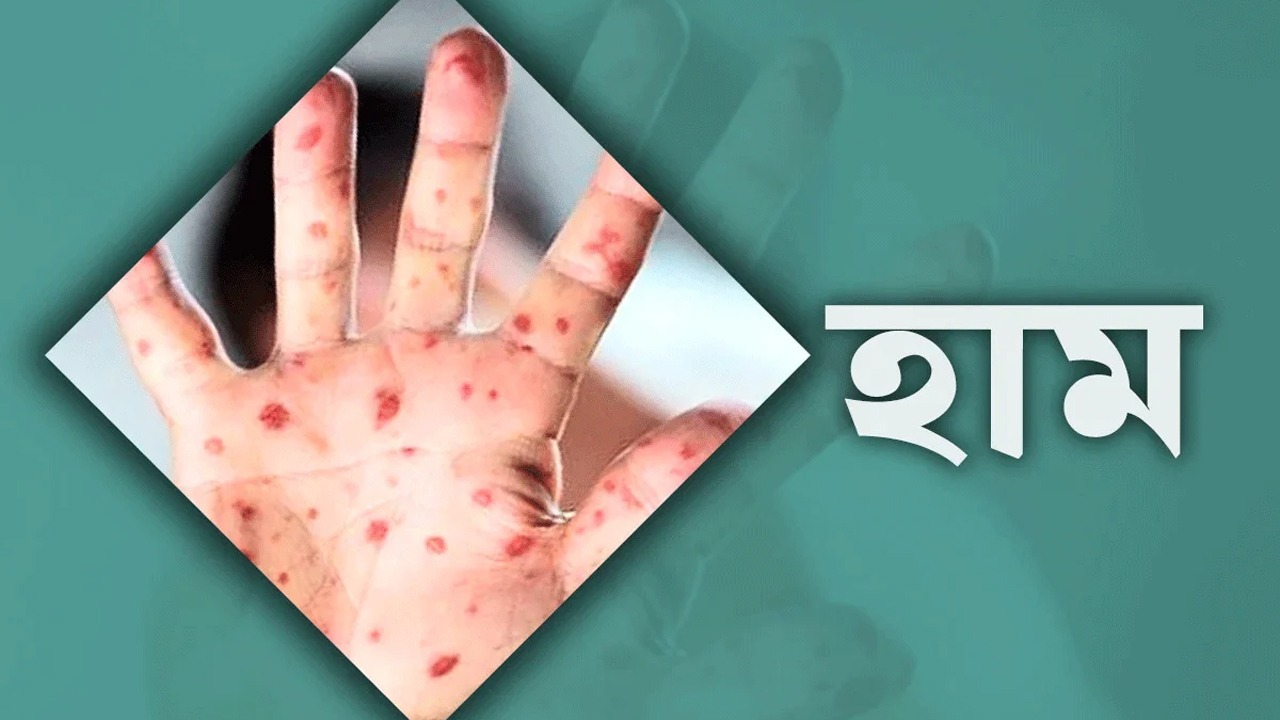 হামের উপসর্গে আরও ৭ জনের মৃত্যু, আক্রান্ত ১৩২৭