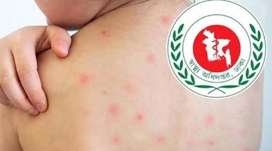 একদিনে হাম উপসর্গে আরও ৩ জনের প্রাণহানি