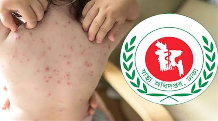 হাম ও উপসর্গে ২৪ ঘণ্টায় আরও ১০ শিশুর মৃত্যু