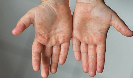 সিলেটে হামের প্রকোপ বাড়ছে আরও এক শিশুর মৃত্যু