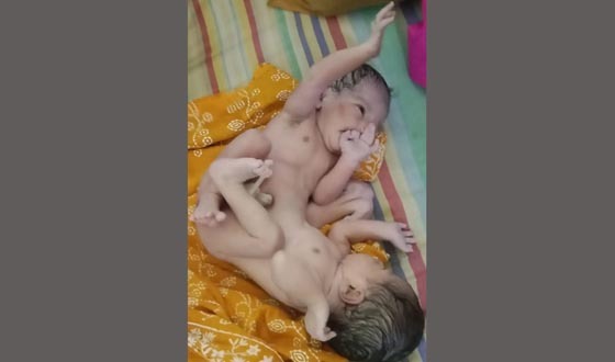 চাঁদপুরে দুই মাথা নিয়ে শিশুর জন্ম